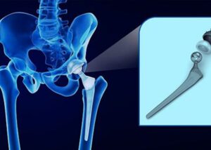 Rehabilitacja po endoprotezie biodra