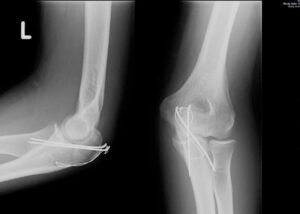 Złamanie wyrostka łokciowego